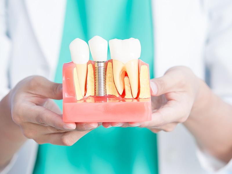 周囲の歯への影響の最小化